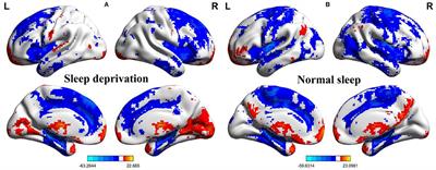 Altered Percent Amplitude of Fluctuation in Healthy Subjects After 36 h Sleep Deprivation